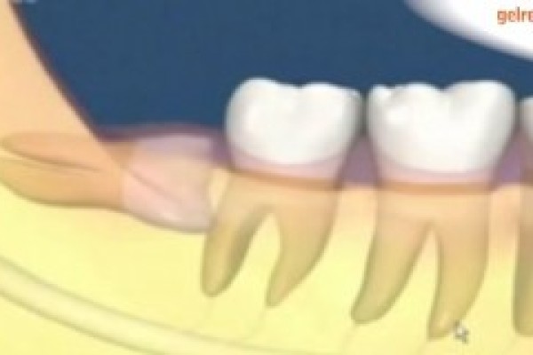Chirurgische verwijdering van kies of tand