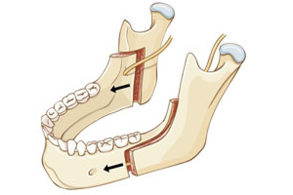 Kaakoperatie of osteotomie